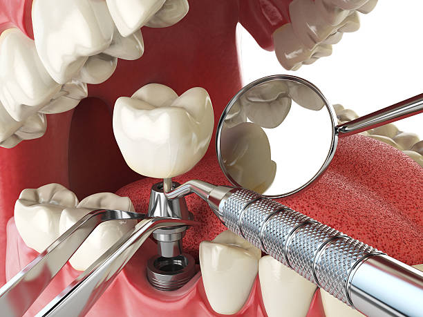 Best Emergency Tooth Extraction in Oxon Hill, MD